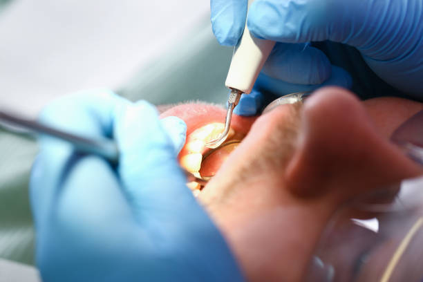 Best Emergency Tooth Extraction in Lowry Crossing, TX